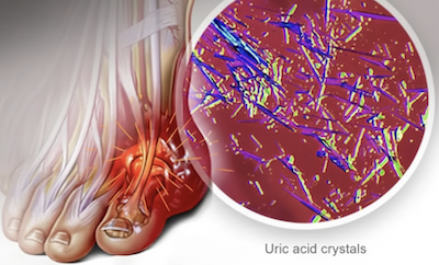 How to lower uric acid levels naturally with diet, hydration, and lifestyle changes