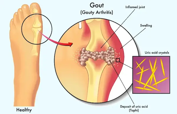 Healthy diet for high uric acid and gout showing low-purine foods